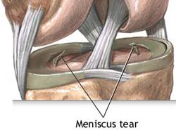 Meniscaltears